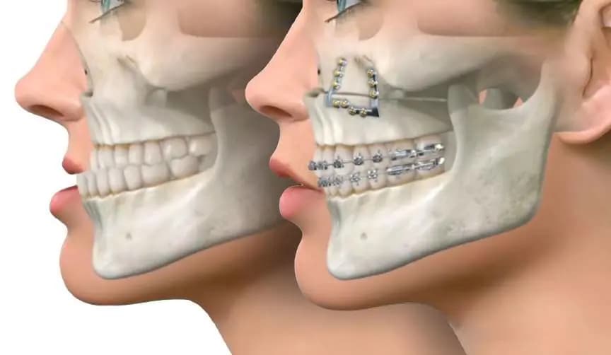 3D jaw model used for orthognathic planning