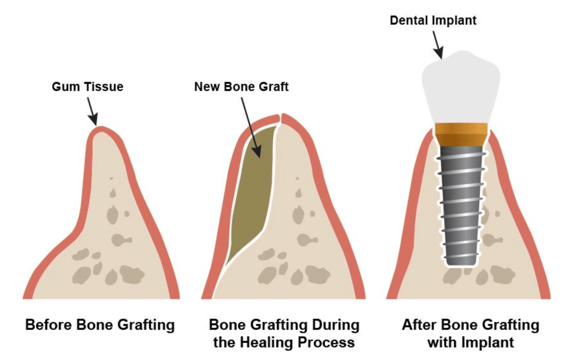 3D imaging scan for bone graft planning